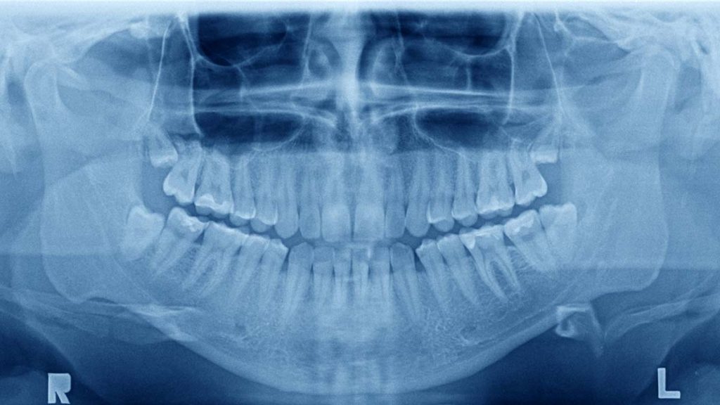 Osteoporosis can be detected in dentistry –