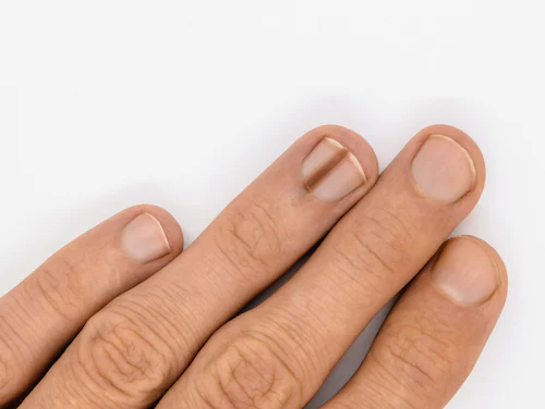 Brown streaks in the nails can have several causes, including a type of malignant melanoma.
