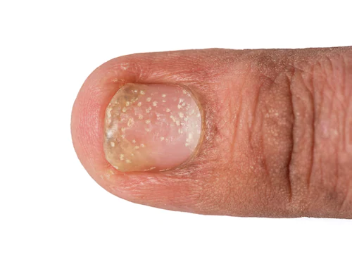 A symptom of nail psoriasis is, among other things, small, round pits on the nails.