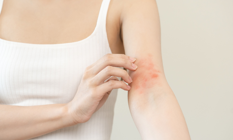 Atopic eczema – treatments and symptoms