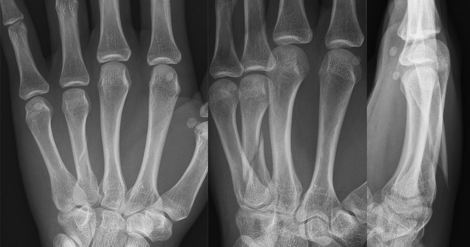 Active training without surgery is as useful as surgery and plastering for metatarsal fractures